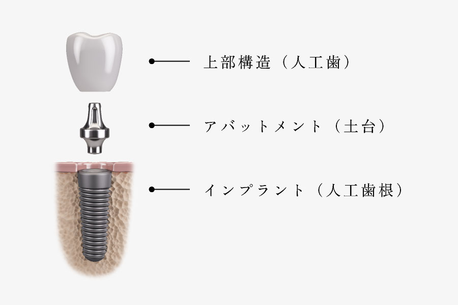 上部構造（人工歯）／アバットメント（土台）／インプラント（人工歯根）