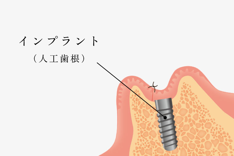 インプラント（人工歯根）