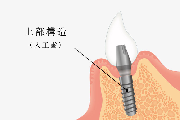 上部構造（人工歯）