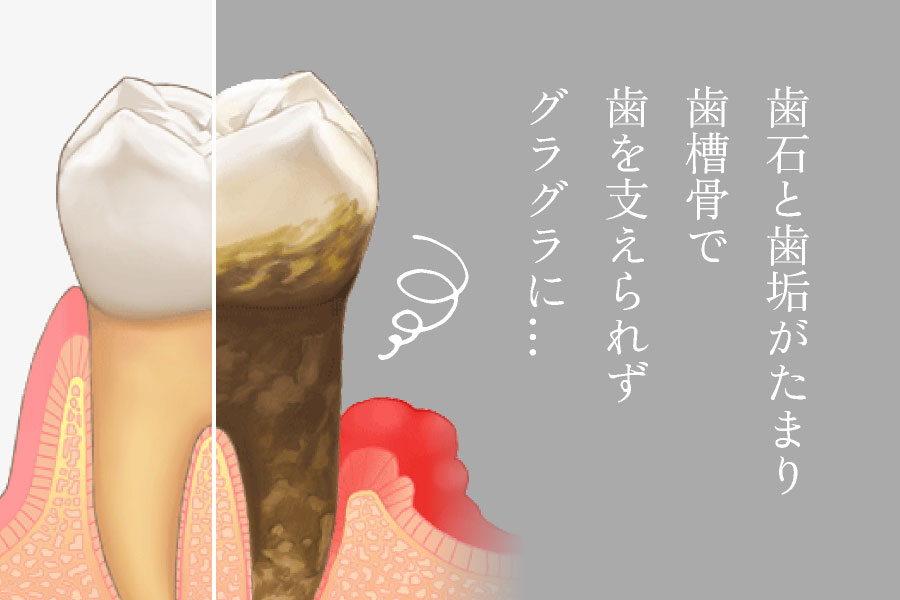 歯石と歯垢がたまり、歯槽骨で歯を支えられずグラグラに…