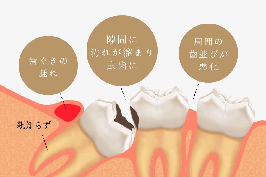 親知らず　歯茎の腫れ　隙間に汚れが溜まり虫歯に　周囲の歯並びが悪化
